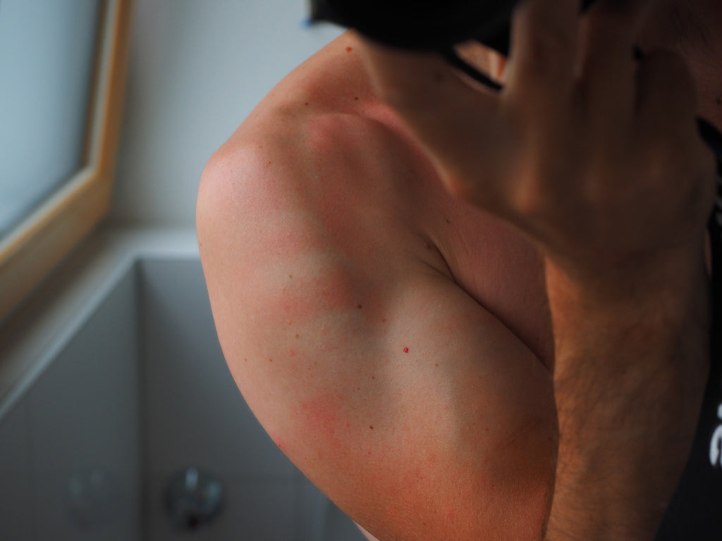 What if we got sunburnt? ——5 Ways to Treat a Sunburn
